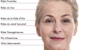 Schéma anatomique des muscles faciaux impliqués dans la formation des rides du sourire et du front.